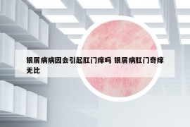 銀屑病病因會引起肛門癢嗎 銀屑病肛門奇癢無比