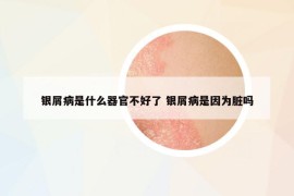 銀屑病是什么器官不好了 銀屑病是因為臟嗎