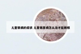 兒童銀病的癥狀 兒童銀屑病怎么治才能斷根