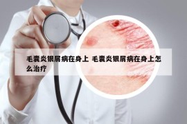 毛囊炎銀屑病在身上 毛囊炎銀屑病在身上怎么治療