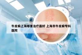牛皮癬上海哪里治療最好 上海市牛皮癬?？漆t(yī)院