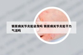 銀屑病關節(jié)炎能染發(fā)嗎 銀屑病關節(jié)炎能干力氣活嗎
