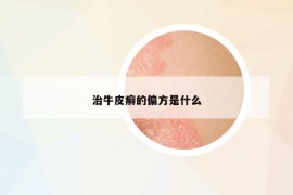 治牛皮癬的偏方是什么