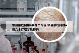 銀屑病吃阿維a要幾個(gè)療程 銀屑病吃阿維a要幾個(gè)療程才能停藥