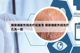 銀屑病紫外線光療后復(fù)發(fā) 銀屑病紫外線光療幾天一做