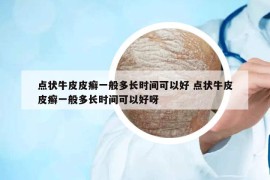 點狀牛皮皮癬一般多長時間可以好 點狀牛皮皮癬一般多長時間可以好呀