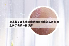 身上長了許多類似癬狀的特別癢怎么回事 身上長了像癬一樣很癢