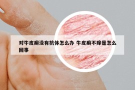 對牛皮癬沒有抗體怎么辦 牛皮癬不癢是怎么回事