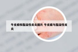 牛皮癬和脂溢性皮炎圖片 牛皮廨與脂溢性皮炎