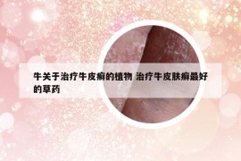 牛關(guān)于治療牛皮癬的植物 治療牛皮膚癬最好的草藥