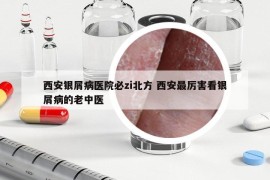 西安銀屑病醫(yī)院必zi北方 西安最厲害看銀屑病的老中醫(yī)