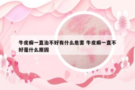 牛皮癬一直治不好有什么危害 牛皮癬一直不好是什么原因