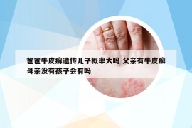 爸爸牛皮癬遺傳兒子概率大嗎 父親有牛皮癬母親沒(méi)有孩子會(huì)有嗎