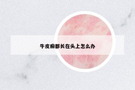 牛皮癬都長在頭上怎么辦
