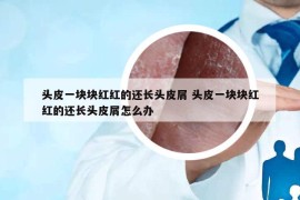 頭皮一塊塊紅紅的還長頭皮屑 頭皮一塊塊紅紅的還長頭皮屑怎么辦