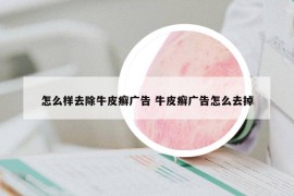 怎么樣去除牛皮癬廣告 牛皮癬廣告怎么去掉