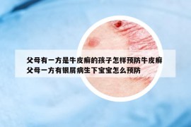 父母有一方是牛皮癬的孩子怎樣預(yù)防牛皮癬 父母一方有銀屑病生下寶寶怎么預(yù)防