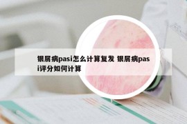 銀屑病pasi怎么計算復(fù)發(fā) 銀屑病pasi評分如何計算