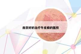 南京好的治療牛皮癬的醫(yī)院