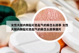 女性大腿內(nèi)側(cè)起紅色起氣的癬怎么回事 女性大腿內(nèi)側(cè)起紅色起氣的癬怎么回事圖片