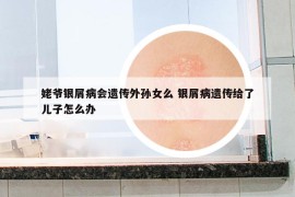 姥爺銀屑病會(huì)遺傳外孫女么 銀屑病遺傳給了兒子怎么辦