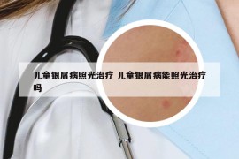兒童銀屑病照光治療 兒童銀屑病能照光治療嗎