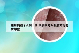 銀屑病毀了人的一生 銀屑病對(duì)人的最大傷害有哪些