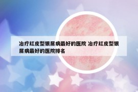 冶療紅皮型銀屑病最好的醫(yī)院 冶療紅皮型銀屑病最好的醫(yī)院排名