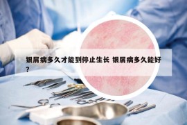 銀屑病多久才能到停止生長(zhǎng) 銀屑病多久能好?