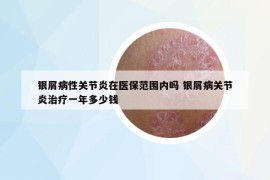 銀屑病性關(guān)節(jié)炎在醫(yī)保范圍內(nèi)嗎 銀屑病關(guān)節(jié)炎治療一年多少錢