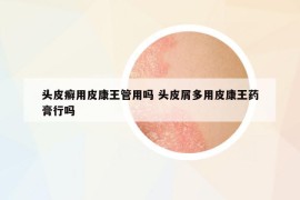 頭皮癬用皮康王管用嗎 頭皮屑多用皮康王藥膏行嗎
