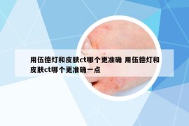 用伍德燈和皮膚ct哪個(gè)更準(zhǔn)確 用伍德燈和皮膚ct哪個(gè)更準(zhǔn)確一點(diǎn)