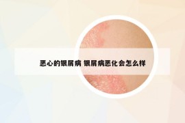 惡心的銀屑病 銀屑病惡化會(huì)怎么樣