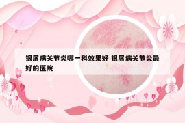 銀屑病關節(jié)炎哪一科效果好 銀屑病關節(jié)炎最好的醫(yī)院