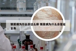 銀屑病為什么會(huì)這么癢 銀屑病為什么會(huì)蔓延全身