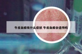 牛皮血癬有什么癥狀 牛皮血癬會(huì)遺傳嗎