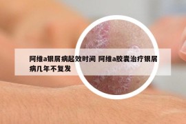 阿維a銀屑病起效時(shí)間 阿維a膠囊治療銀屑病幾年不復(fù)發(fā)