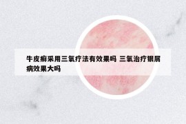 牛皮癬采用三氧療法有效果嗎 三氧治療銀屑病效果大嗎