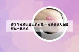 穿了牛皮癬人穿過的衣服 牛皮膚癬病人衣服可以一起洗嗎
