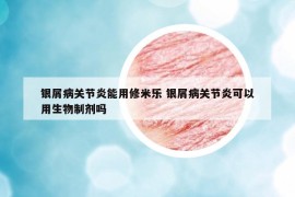 銀屑病關(guān)節(jié)炎能用修米樂(lè) 銀屑病關(guān)節(jié)炎可以用生物制劑嗎