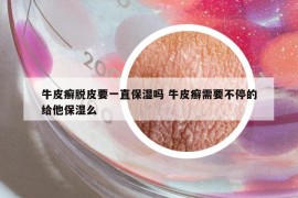 牛皮癬脫皮要一直保濕嗎 牛皮癬需要不停的給他保濕么