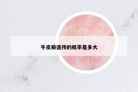 牛皮癬遺傳的概率是多大