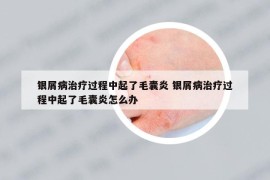 銀屑病治療過程中起了毛囊炎 銀屑病治療過程中起了毛囊炎怎么辦