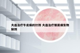 大連治療牛皮癬的針劑 大連治療銀屑病生物制劑