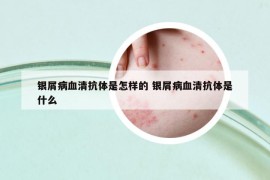 銀屑病血清抗體是怎樣的 銀屑病血清抗體是什么
