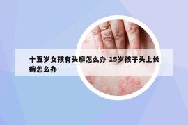 十五歲女孩有頭癬怎么辦 15歲孩子頭上長(zhǎng)癬怎么辦