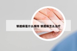 銀翹癬是什么模樣 銀翹癬怎么治療