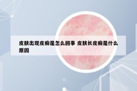 皮膚出現(xiàn)皮癬是怎么回事 皮膚長皮癬是什么原因