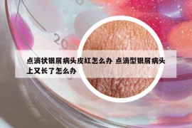 點(diǎn)滴狀銀屑病頭皮紅怎么辦 點(diǎn)滴型銀屑病頭上又長了怎么辦