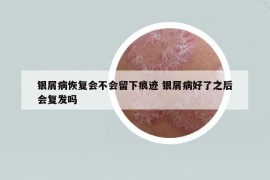 銀屑病恢復(fù)會(huì)不會(huì)留下痕跡 銀屑病好了之后會(huì)復(fù)發(fā)嗎